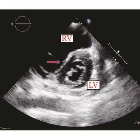 d shaped ventricle ph.